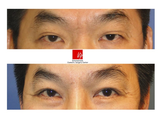 眼部 - 内窥镜前额提升 & 上眼睑手术
