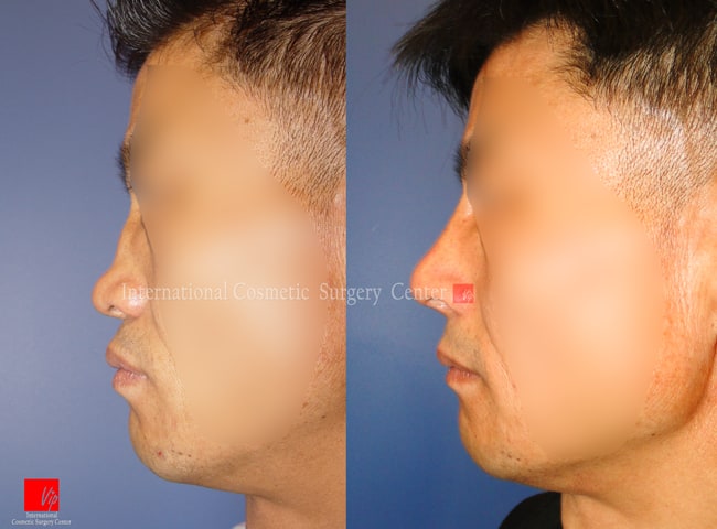 鼻部 - 矮平鼻矫正手术—肋软骨隆鼻
