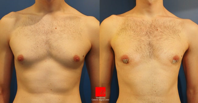 胸部 - 男性乳房手术