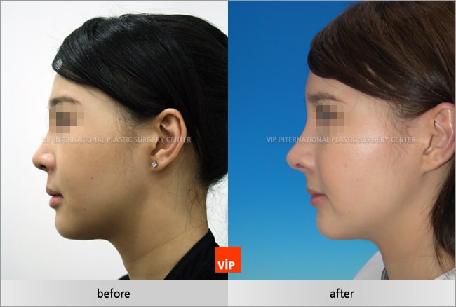 鼻部 - 和谐隆鼻术—打造完美侧颜线