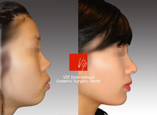 鼻部 - VIP和谐隆鼻术