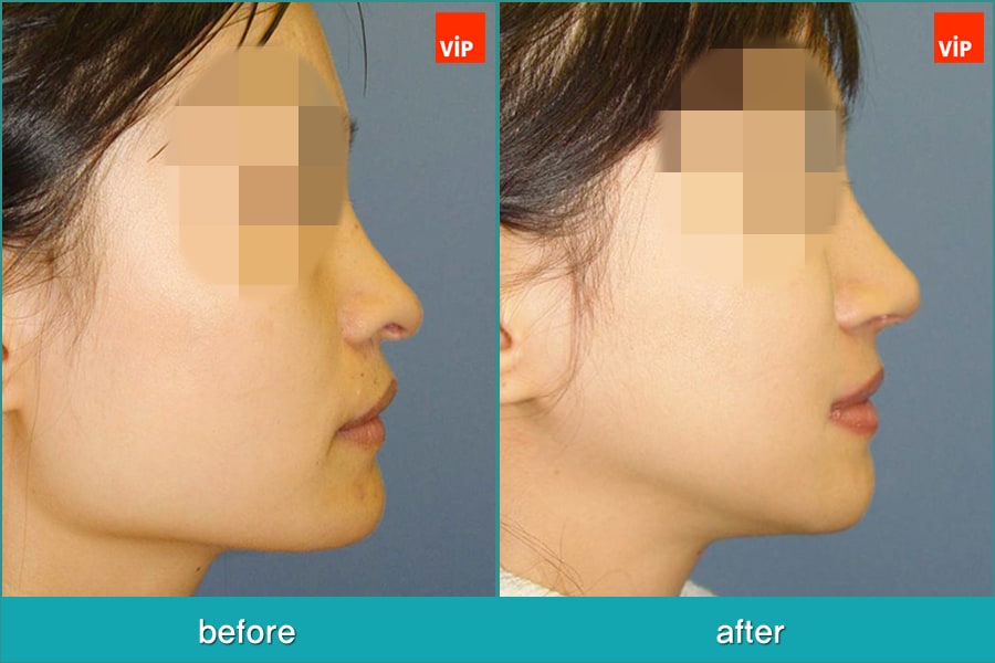 鼻部, 面部 - 隆鼻和鼻中隔偏斜手术，面部轮廓手术，下颌线手术
