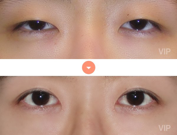 眼部 - 双眼皮手术