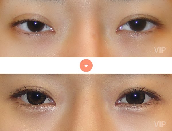 眼部 - 双眼皮手术