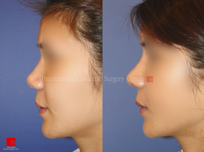 鼻部 - 脸部和谐手术