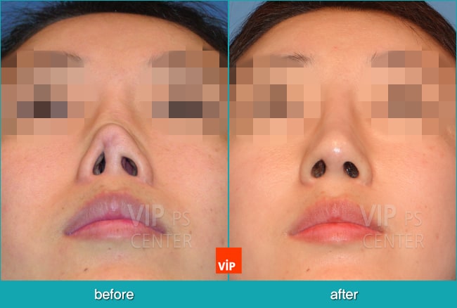 鼻部 - 鼻部修复手术—肋软骨隆鼻