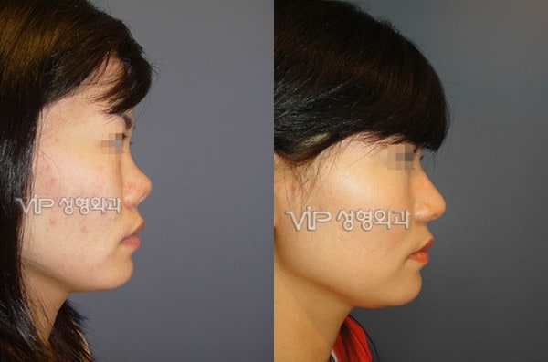 鼻部 - 硅胶隆鼻手术修复 - 肋软骨隆鼻