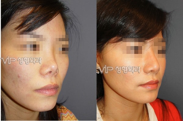 鼻部 - 硅胶隆鼻手术修复 - 肋软骨隆鼻