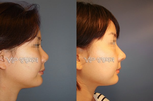鼻部 - 鼻部修复手术-肋软骨隆鼻