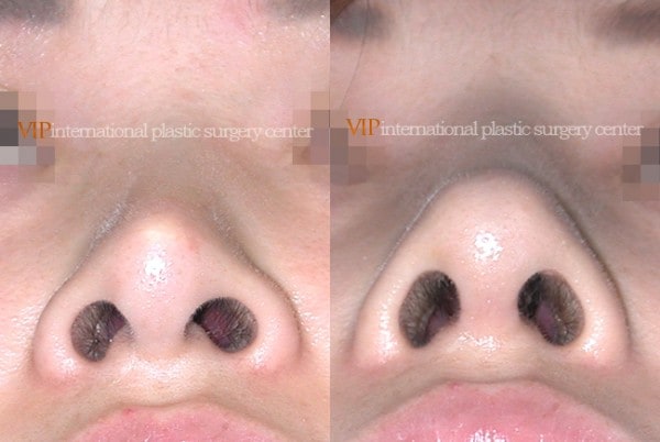 鼻部 - 隆鼻修复手术