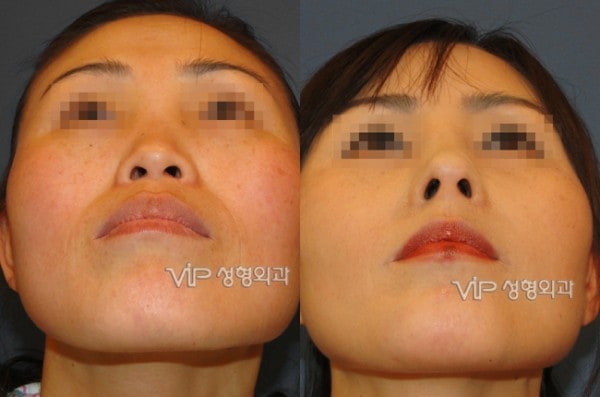 鼻部 - VIP 和谐隆鼻手术