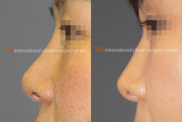 鼻部 - 隆鼻修复手术