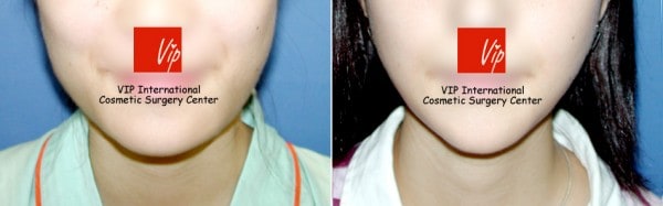 面部 - V型脸手术