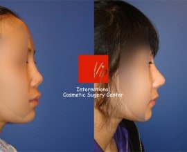 硅胶隆鼻修复手术-肋软骨隆鼻