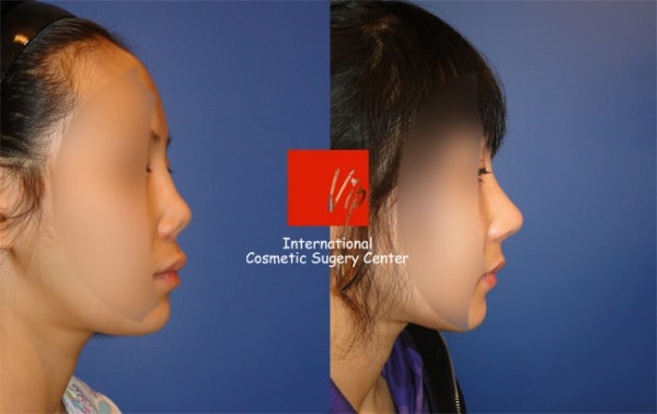 鼻部 - 硅胶隆鼻修复手术-肋软骨隆鼻