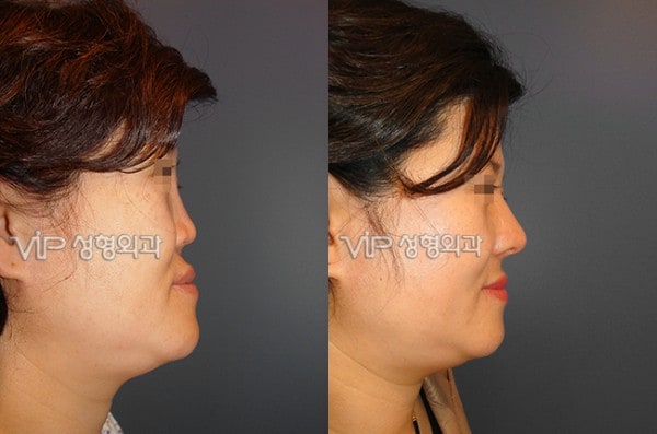 鼻部 - 硅胶隆鼻手术修复-肋软骨隆鼻