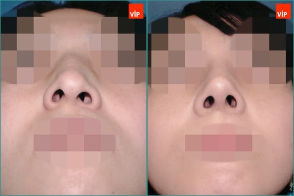 鼻部 - 驼峰鼻鼻中隔鼻整形术