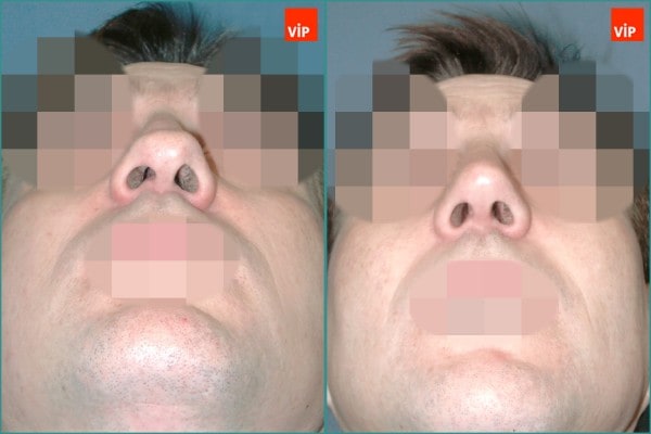 鼻部 - 驼峰鼻鼻中隔鼻整形术， 中脸提升
