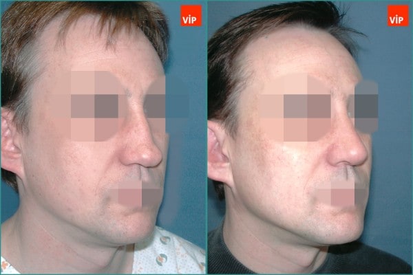 鼻部 - 驼峰鼻鼻中隔鼻整形术， 中脸提升