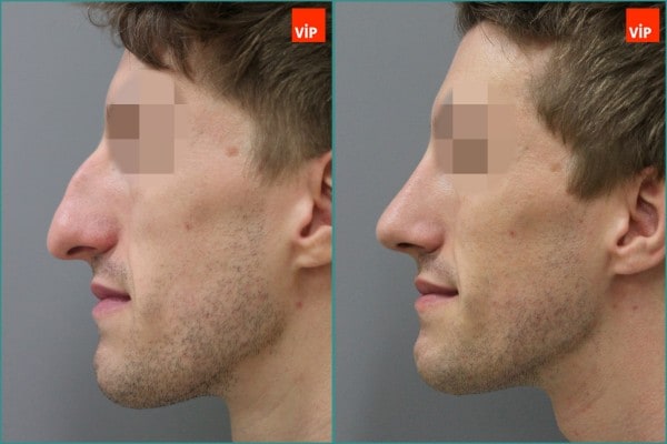 鼻部 - 鼻中隔软骨鼻整形术，驼峰鼻