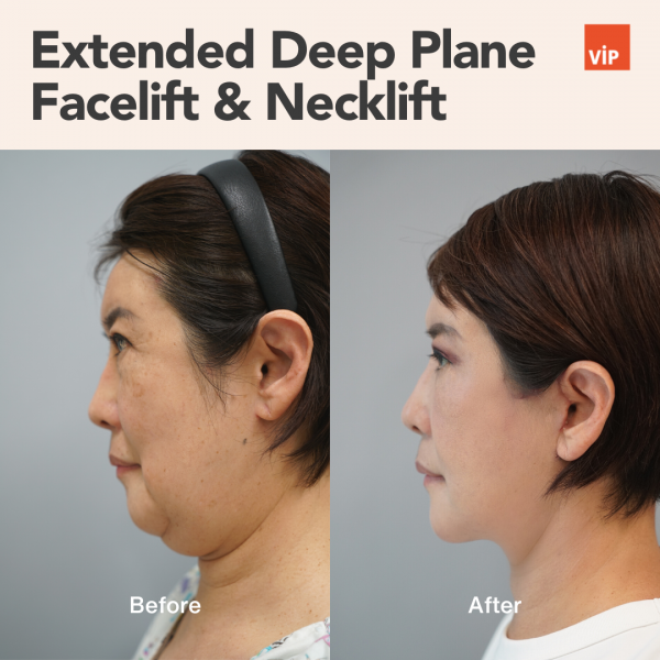 提升术 - Extended Deep Plane Facelift & Necklift