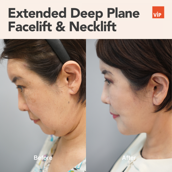 提升术 - Extended Deep Plane Facelift & Necklift