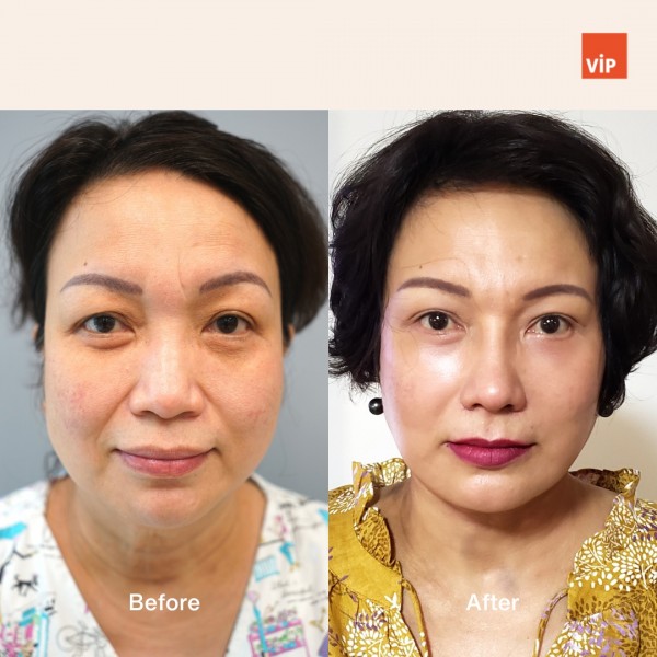 鼻部, 面部 - Deep Plane Facelift, Neck lift, & Asian Rib Cartilage Rhinoplasty, Mid Face Augmentation