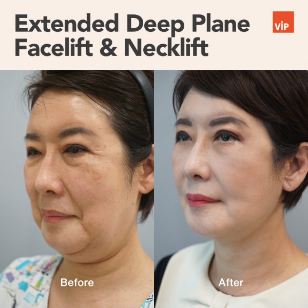 提升术 - Extended Deep Plane Facelift & Necklift