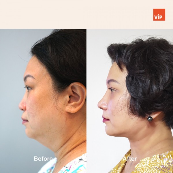 鼻部, 面部 - Deep Plane Facelift, Neck lift, & Asian Rib Cartilage Rhinoplasty, Mid Face Augmentation