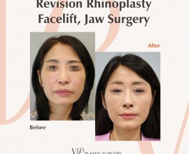 鼻子修复手术，面部除皱，下巴手术