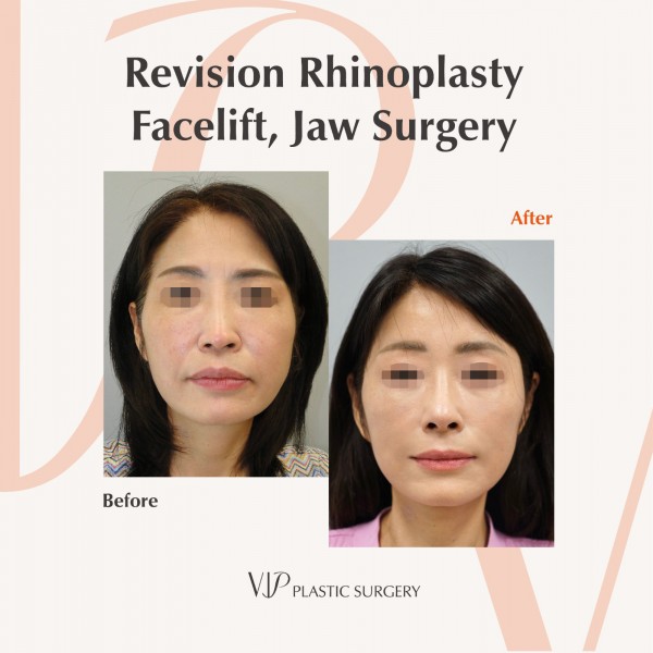 鼻部, 面部, 提升术 - 鼻子修复手术，面部除皱，下巴手术