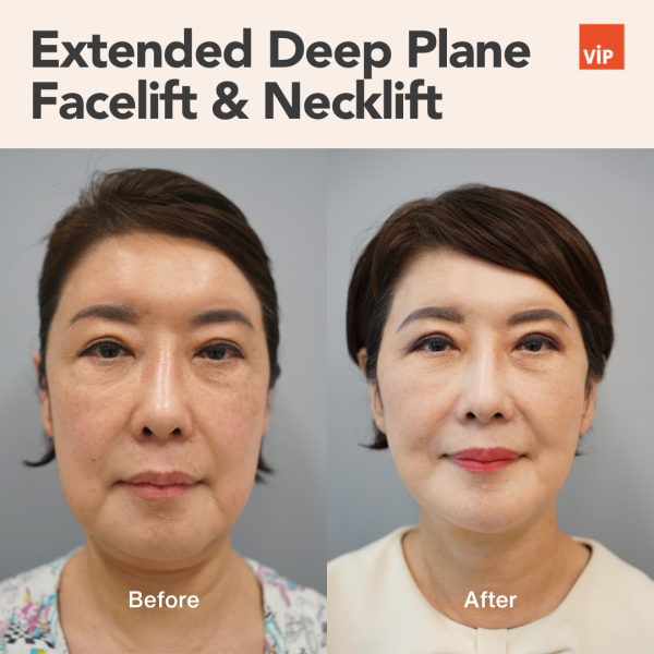 提升术 - Extended Deep Plane Facelift & Necklift