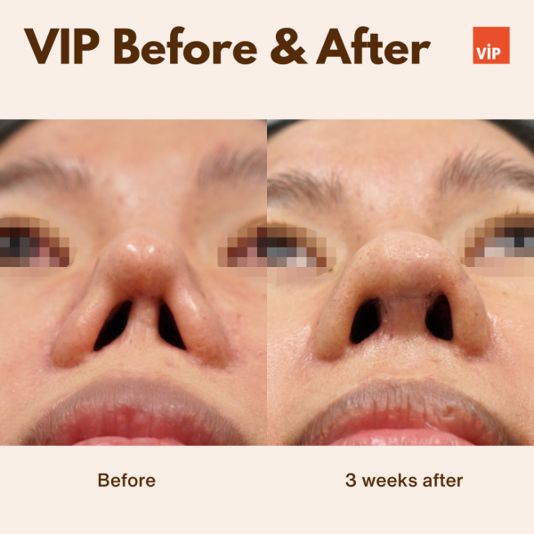 鼻部 - Rib Cartilage Revision Rhinoplasty