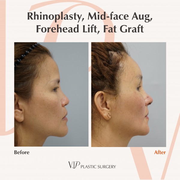 鼻部, 提升术, 干细胞脂肪填充 - Rib cartilage rhinoplasty, Fat graft, Forehead lift
