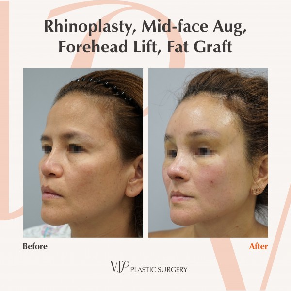 鼻部, 提升术, 干细胞脂肪填充 - Rib cartilage rhinoplasty, Fat graft, Forehead lift