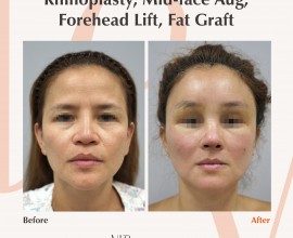Rib cartilage rhinoplasty, Fat graft, Forehead lift