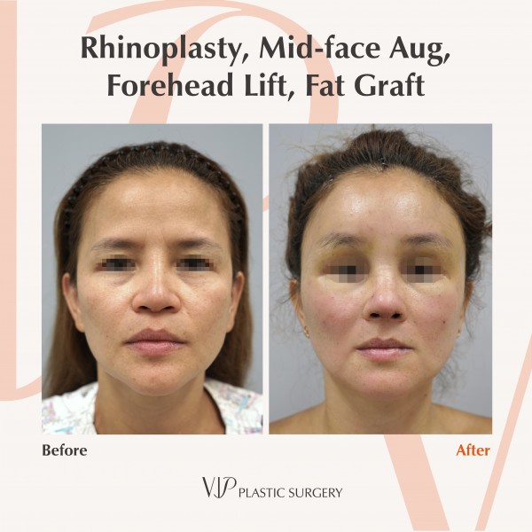 鼻部, 提升术, 干细胞脂肪填充 - Rib cartilage rhinoplasty, Fat graft, Forehead lift