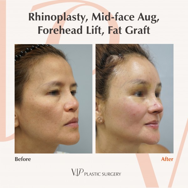 鼻部, 提升术, 干细胞脂肪填充 - Rib cartilage rhinoplasty, Fat graft, Forehead lift