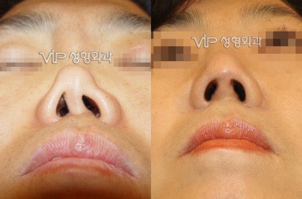 鼻部 - 因硅胶隆鼻感染进行再手术-肋软骨隆鼻