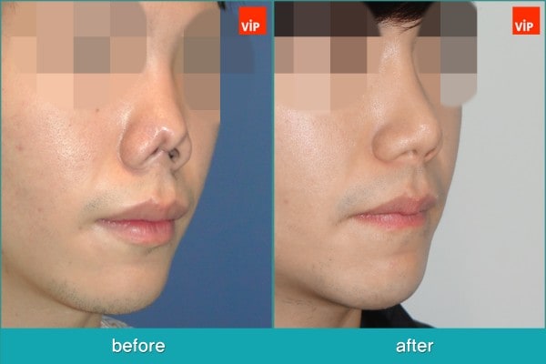 鼻部 - 鼻修复手术