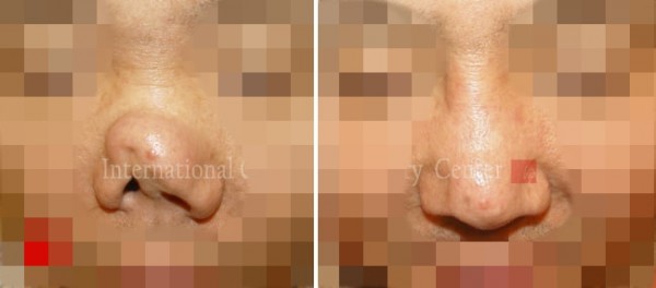 鼻部 - 硅胶假体隆鼻感染修复