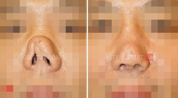鼻部 - 硅胶假体隆鼻感染修复