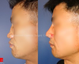 矮平鼻矫正手术—肋软骨隆鼻