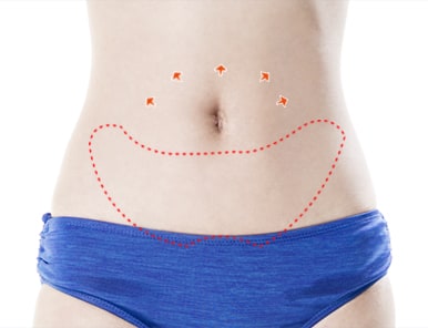 腹部除皱-除去多余的皮肤与脂肪组织