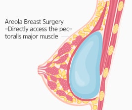 丰胸手术乳晕乳房手术（W乳晕切口法）