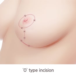 O型切口（乳房提升手术切口类型）