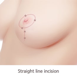 直线切口（乳房提升手术切口类型）