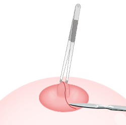 输乳管切口法 -- 不能哺乳手术步骤