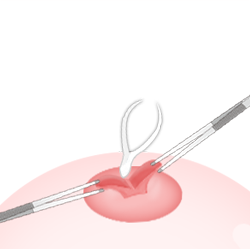 输乳管切口法 -- 不能哺乳手术步骤