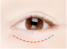 下眼睑手术步骤